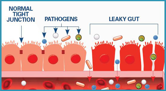 Leaky Gut Barrier